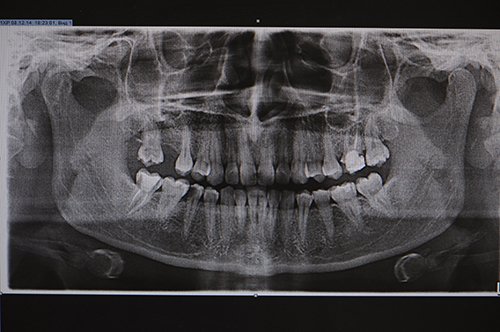 Панорамный снимок зубов Томск Пирогова Лечение кариеса ICON Томск Сельская